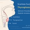 Thyroglossal Cyst - Sistrunk Procedure through Keyhole incisions. Endoscopic Excision of Thyroglossal Cyst, First of its kind in Kerala was performed by Dr. R. Padmkumar and team.