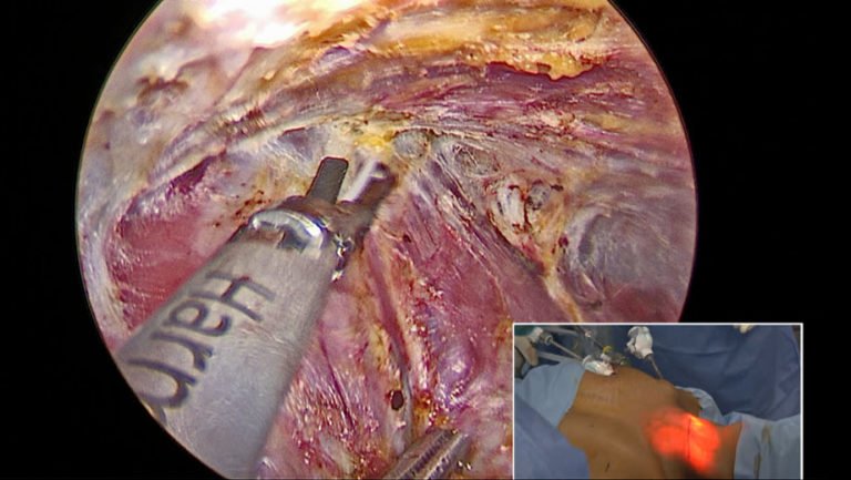 Endoscopic Thyroidectomy at Kochi VPS Lakeshore Hospital