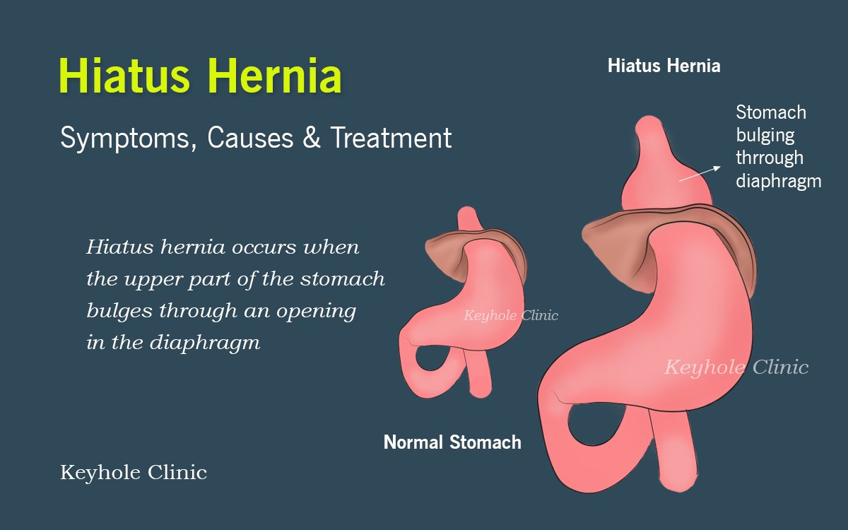 Hiatus Hernia Treatment in India - Hiatus Hernia can be treated laparoscopically through keyhole incisions. Hiatus hernia meaning - when the upper part of the stomach bulges through an opening in the diaphragm