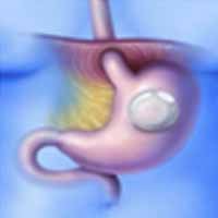 Intragastric balloon for Weight Loss.  