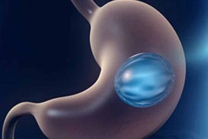 Intragastric Balloon Placement
