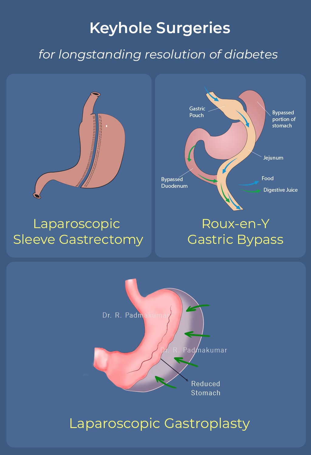 Keyhole Surgeries for longstanding resolution of diabetes. Laparoscopic Sleeve Gastrectomy, Roux-en-Y Gastric Bypass, Laparoscopic Gastroplasty. These are also called metabolic surgeries for diabetes resolution.