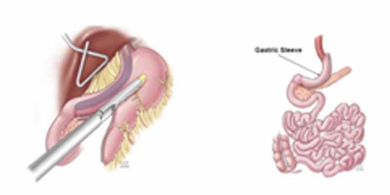 Sleeve Gastrectomy for Obesity - Obesity is related to Infertility