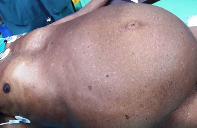 Liposarcoma - Distended Abdomen