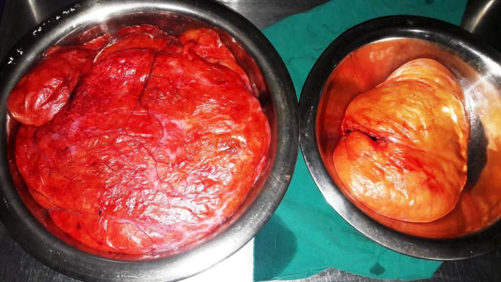Liposarcoma Mass Removed Weighing 4.2 Kg and 1.2 Kg
