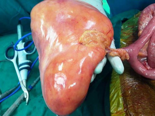 Liposarcoma - Mass