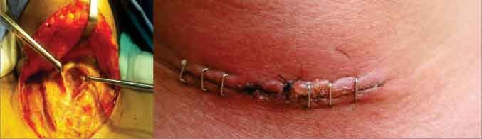Scar with open Thyroidectomy