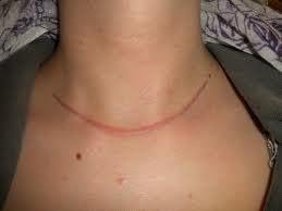 Open Thyroid Surgery Cut made at Neck