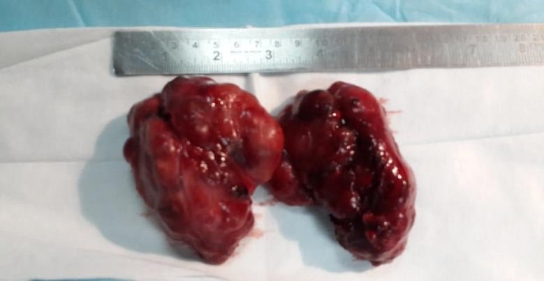 Thyroid removed via Endoscopic Thyroidectomy