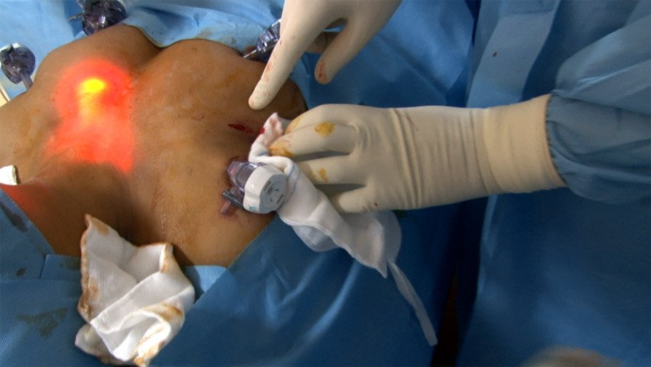 Endoscopic Thyroidectomy Kochi at VPS Lakeshore Hospital