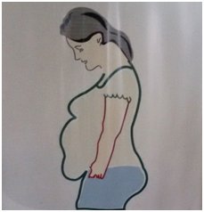 Hanging Abdomen - Tummy Tuck to remove excess fat