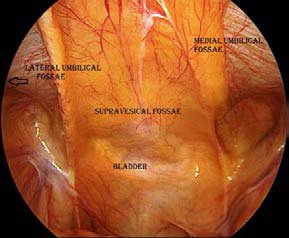 Inguinal Region - Infraumbilical fossae
