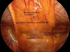 The Infraumbilical ligaments