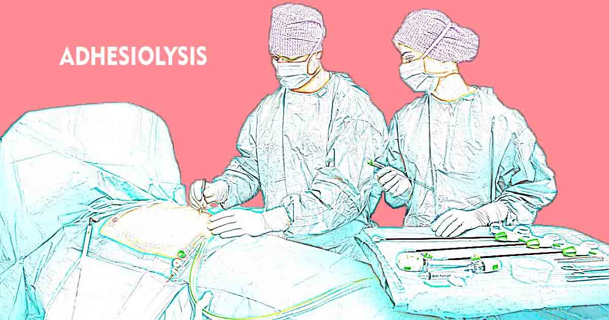 Adhesiolysis