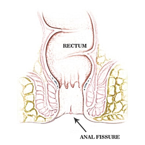 Anal Fissure - is a small tear that occurs in the mucous lining tissues of the anus