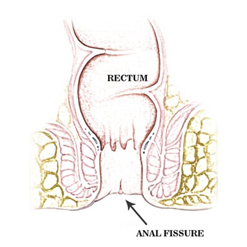 Anal treatment