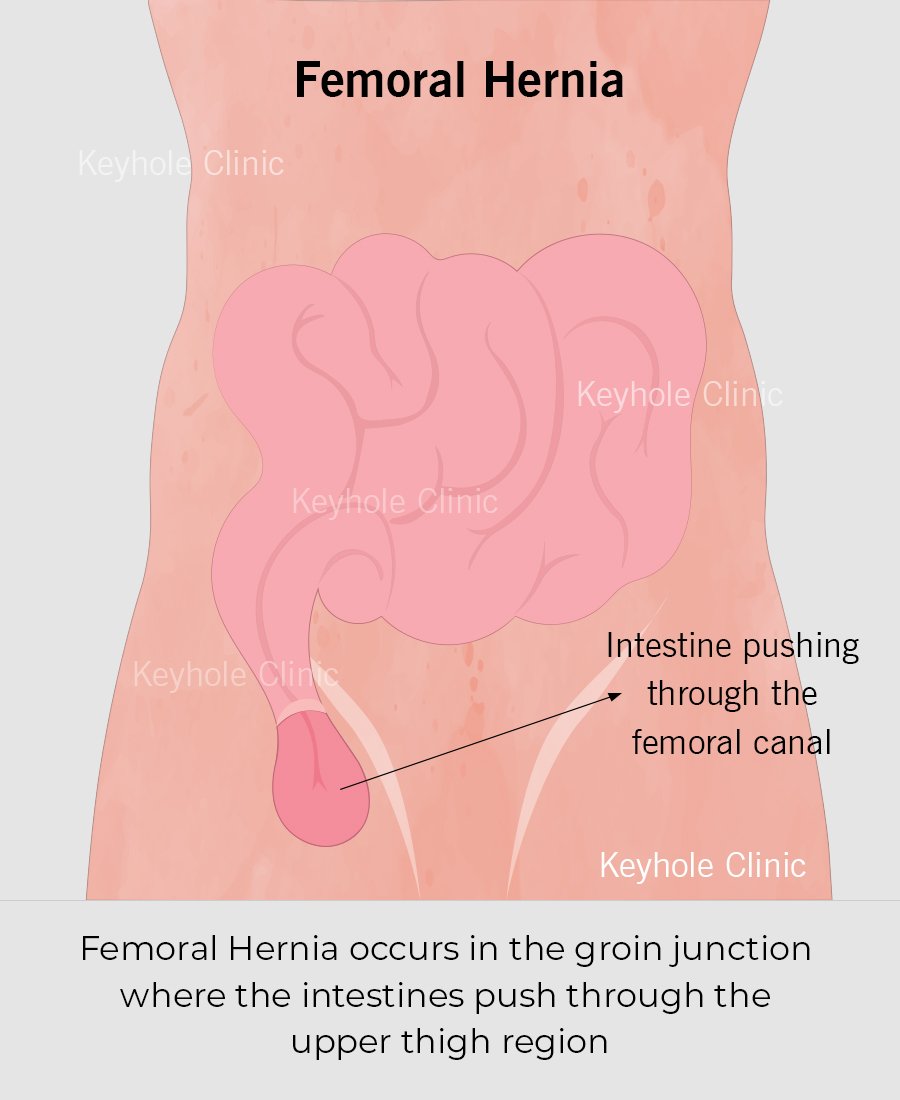 Femoral Hernia occurs in the groin junction where the intestines push through the upper thigh region. Femoral hernia can be reduced laparoscopically (that is with keyhole surgery).
