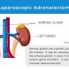 Laparoscopic Adrenalectomy for removing adrenal glands for adrenal gland disorders or adrenal diseases