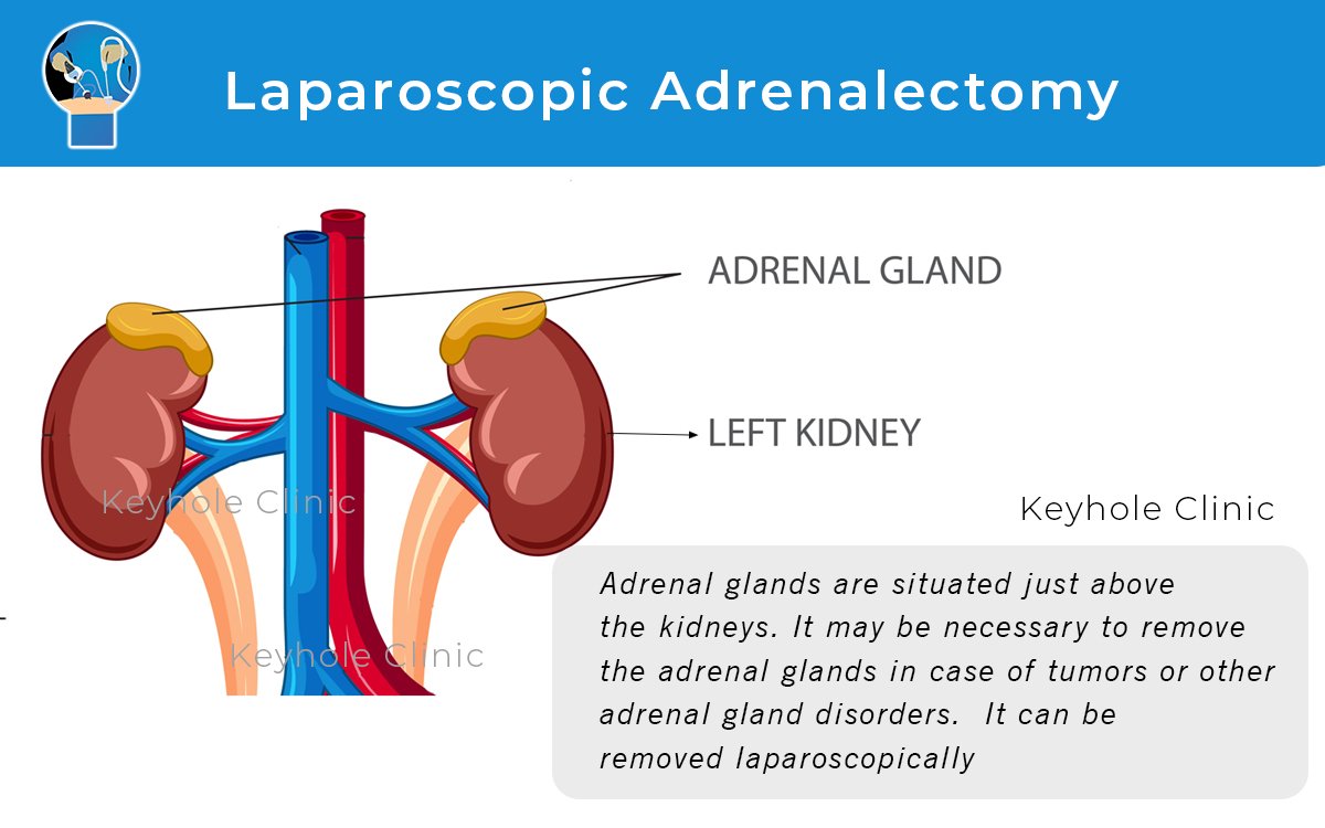Laparoscopic Adrenalectomy for removing adrenal glands for adrenal gland disorders or adrenal diseases