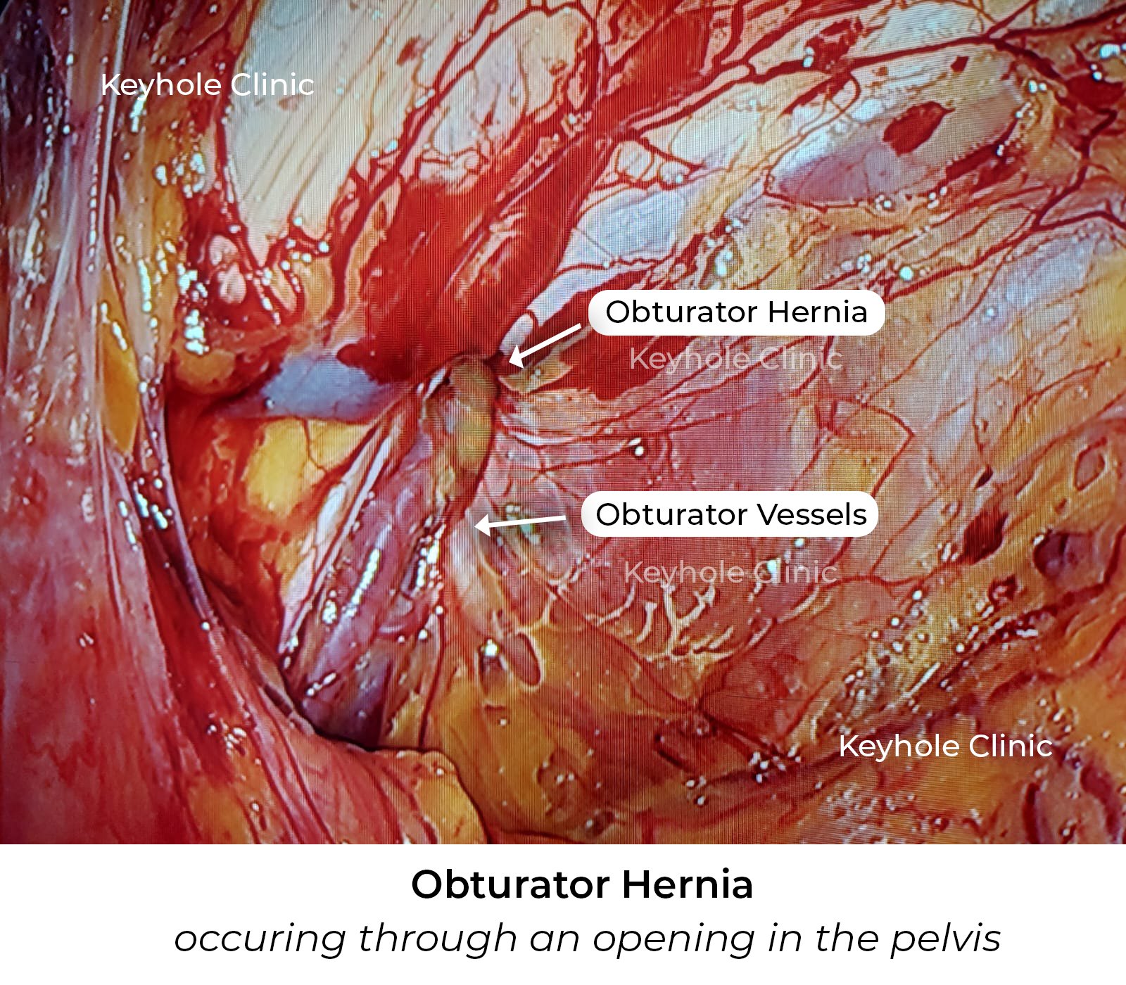 Obturator Hernia - Image showing Obturator hernia occurring through an opening in the pelvis.  Also shows the Obturator Vessels.  