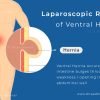 Laparoscopic Ventral Hernia Repair in Kochi - Laparoscopic Ventral Hernia Repair requires much smaller incisions than open surgery, Lowers chance of infection, Less postoperative pain, Reduced hospital stay, Minimal scars, Faster recovery time