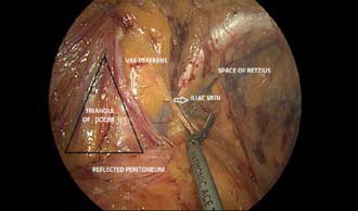 Inguinal Anatomy with Peritoneum Incised - Triangle of Doom