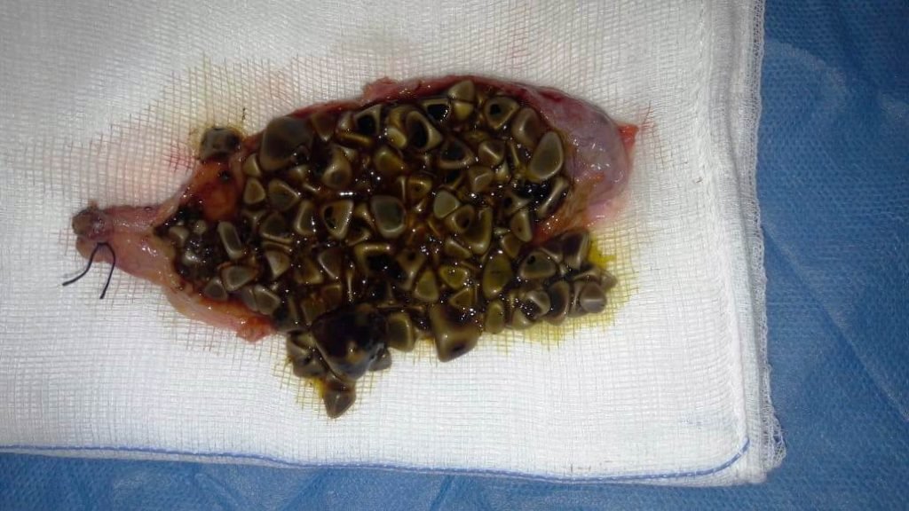 Gallbladder stones - Gallstones is the most common cause of gallbladder disease. They are crystals that form inside the gallbladder.