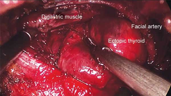 Ectopic thyroid in relation with surrounding structures