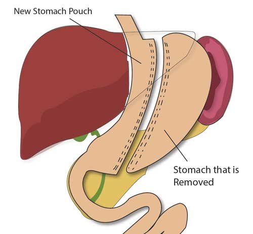 Laparoscopic Sleeve Gastrectomy - Part of Stomach removed