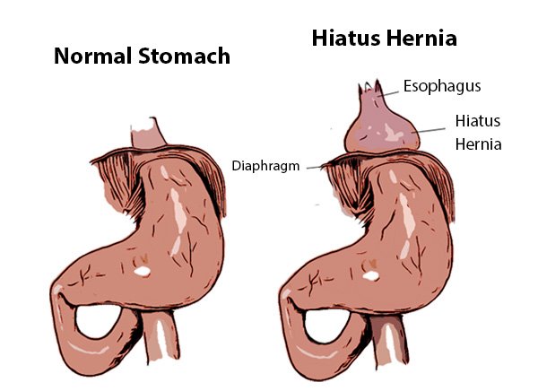 Hiatus Hernia