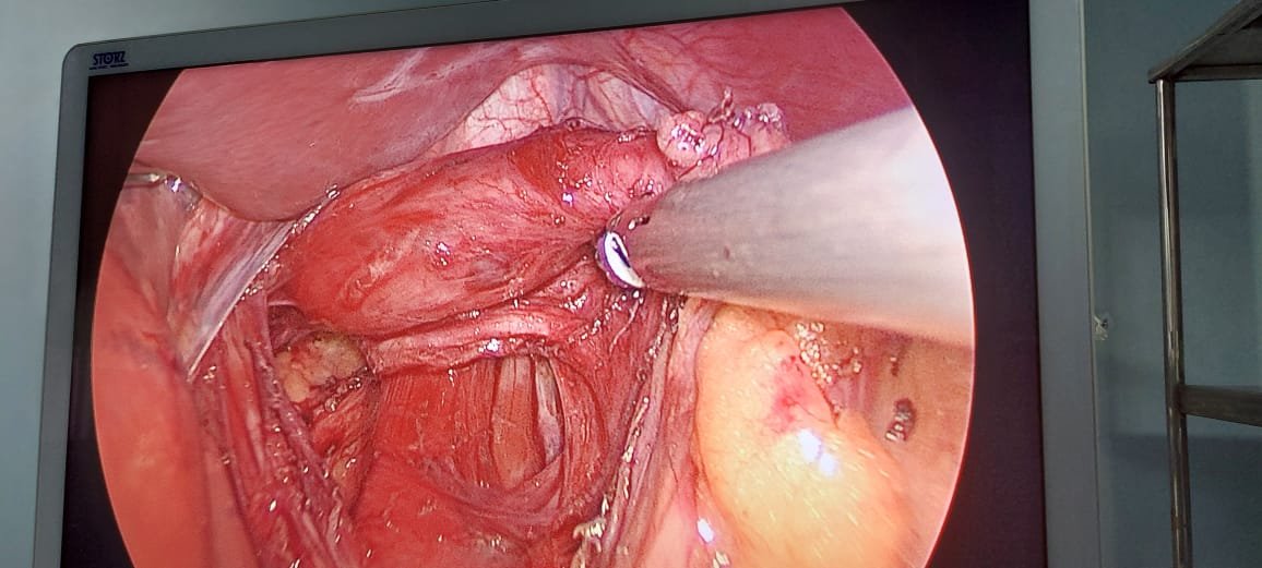 Wide Hiatus - Esophagus with Vagus Nerve – seen on monitor through laparoscope on repair of Hiatal Hernia