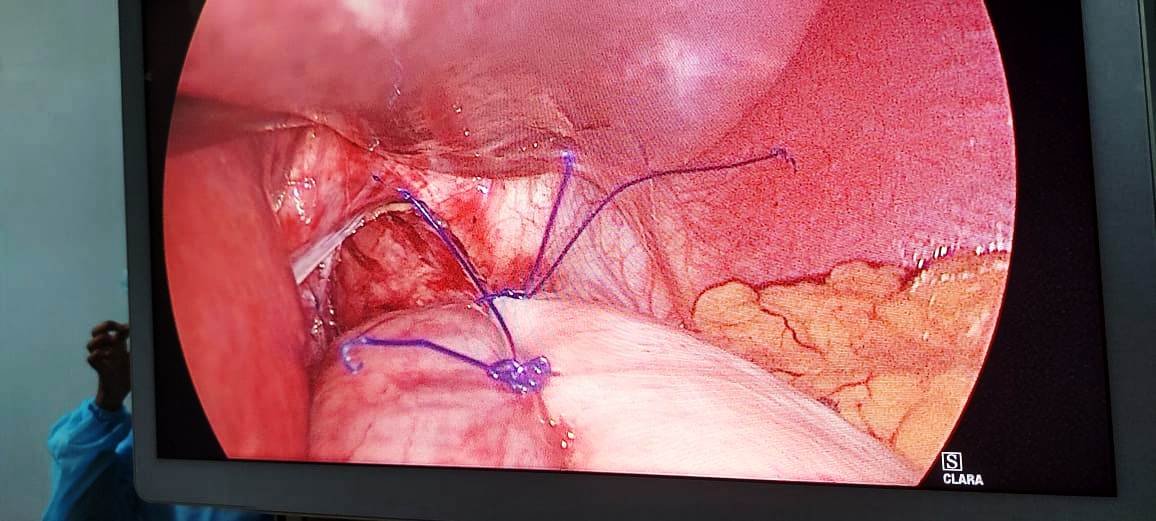 Fundoplication - Stomach wrap around Esophagus