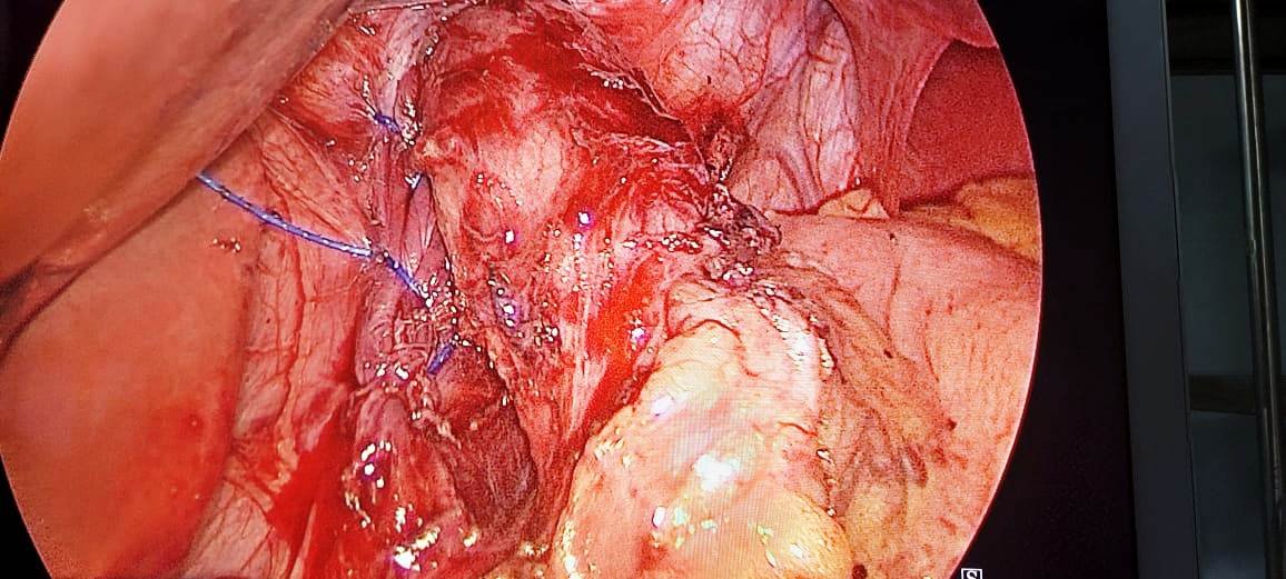 Hiatus Hernia Repair – Hiatus Opening Closed