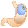 Intragastric Balloon Placement