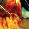 Roux-en-Y Gastric Bypass
