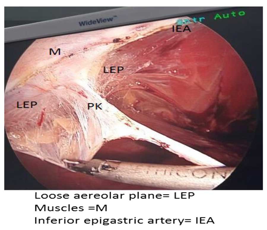 Inferior Epigastric Artery, Loose Aereolar Plane