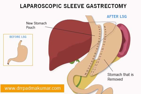Laparoscopic Sleeve Gastrectomy in Kerala, also called Vertical Sleeve Gastrectomy or Gastric Sleeve Procedure