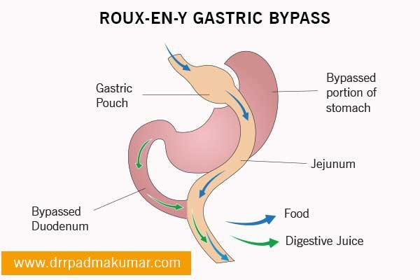 Roux-en-Y Gastric Bypass in Kerala - where stomach is divided into small upper pouch and large lower pouch
