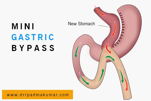 Mini Gastric Bypass Surgery in India