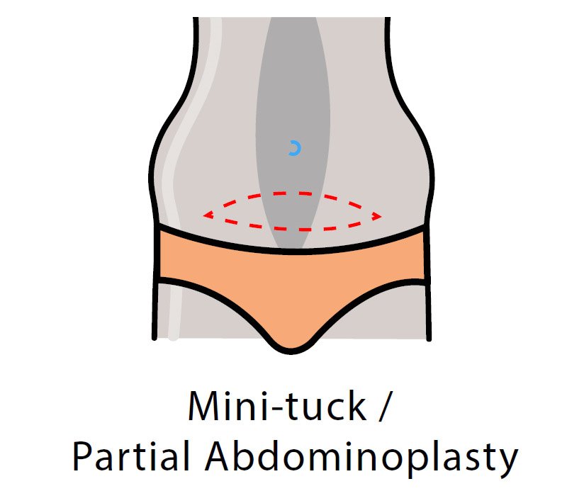Methods of Abdominoplasty - Mini-tuck / Partial Abdominoplasty
