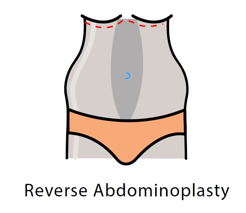 Methods of Abdominoplasty - Reverse Abdominoplasty