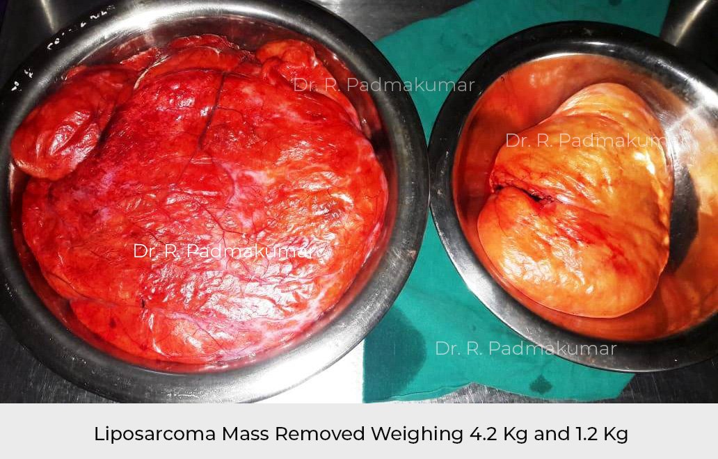 Liposarcoma is a soft tissue sarcoma and starts in the fat cells. Image shows Liposarcoma mass weighing 4.2 kg and 1.2 kg removed from the abdomen.
