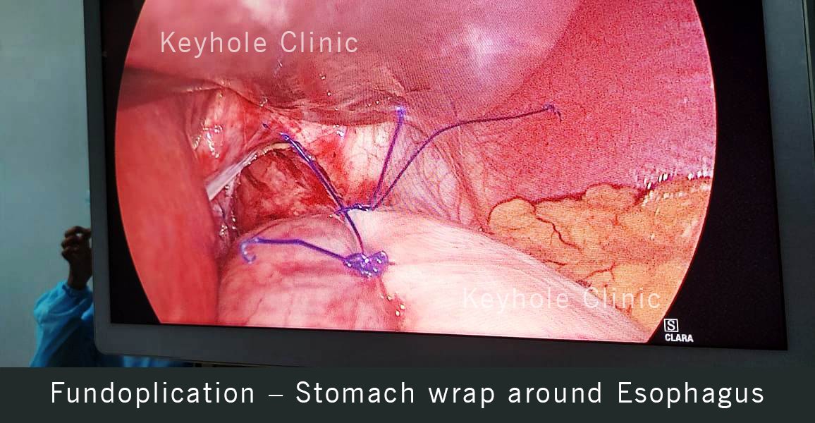Fundoplication - Stomach wrap around Esophagus