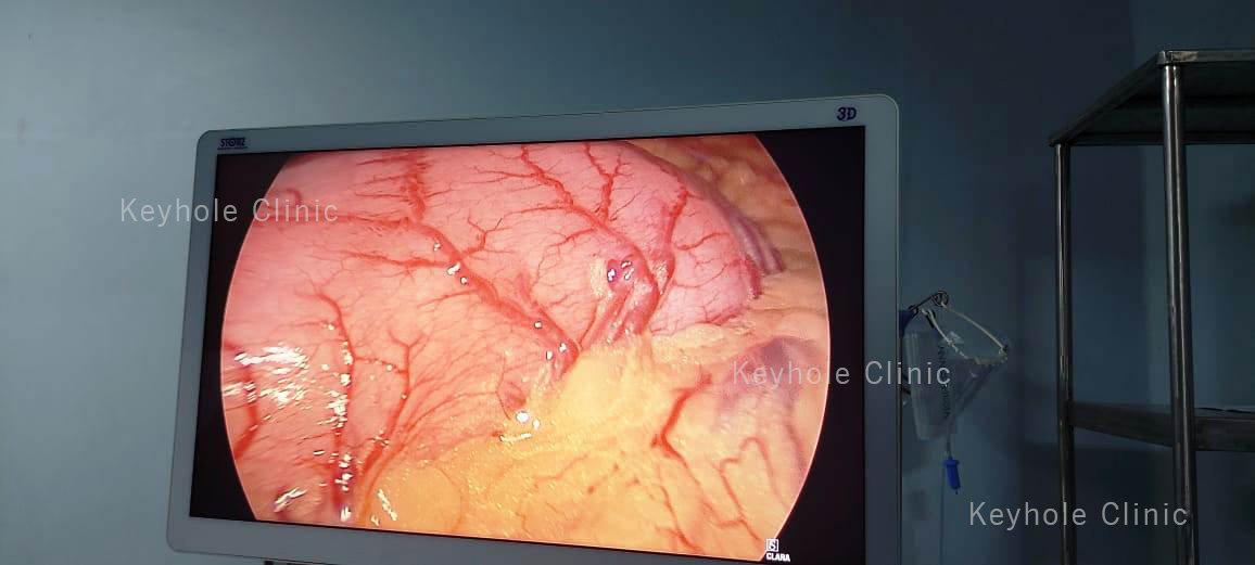 Hiatal Hernia Stomach View using Laparoscope. Laparoscopic Repair of Hiatus Hernia is the gold standard treatment for hiatus hernia