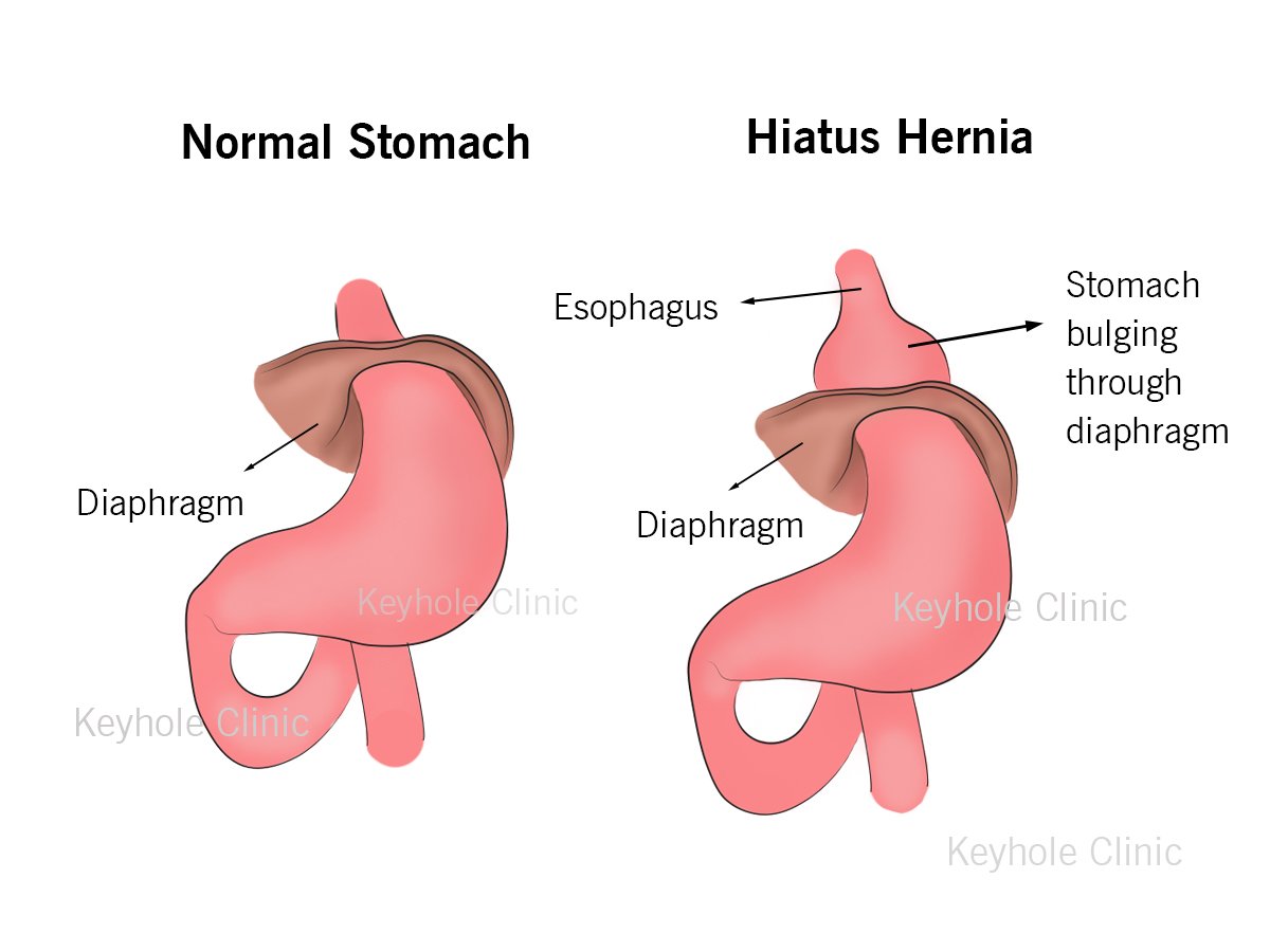 Hiatus Hernia is a condition developed when the upper part of the stomach bulges through an opening in the diaphragm. Hiatus hernia can be repaired Laparoscopically.