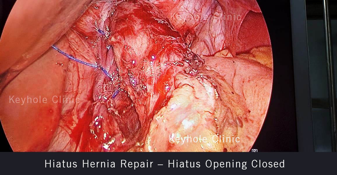 Hiatus Hernia Repair – Hiatus Opening Closed
