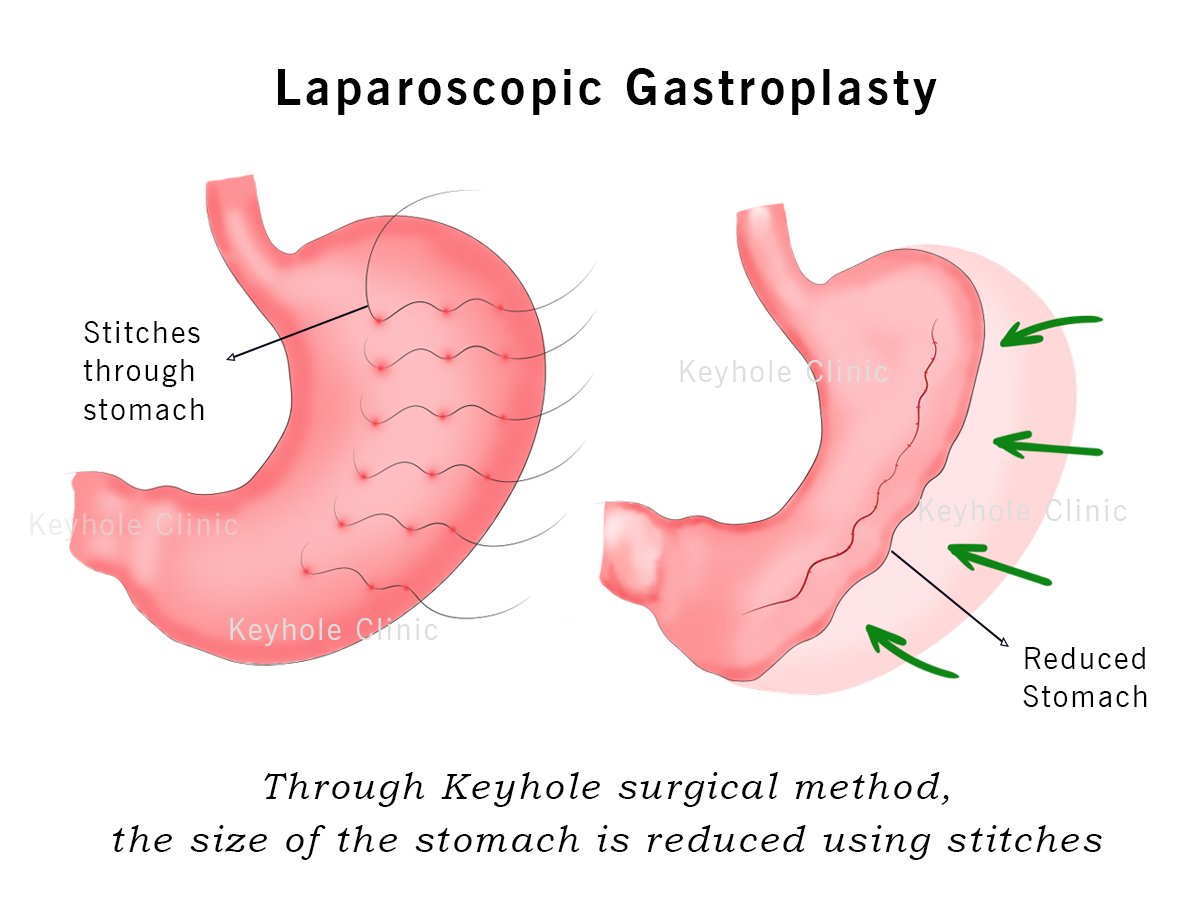 Laparoscopic Gastroplasty is a surgical procedure to decrease the size of the stomach, about 60-70% of the stomach is reduced by stitches.  The cost of laparoscopic gastroplasty is less compared to other bariatric surgery procedures.