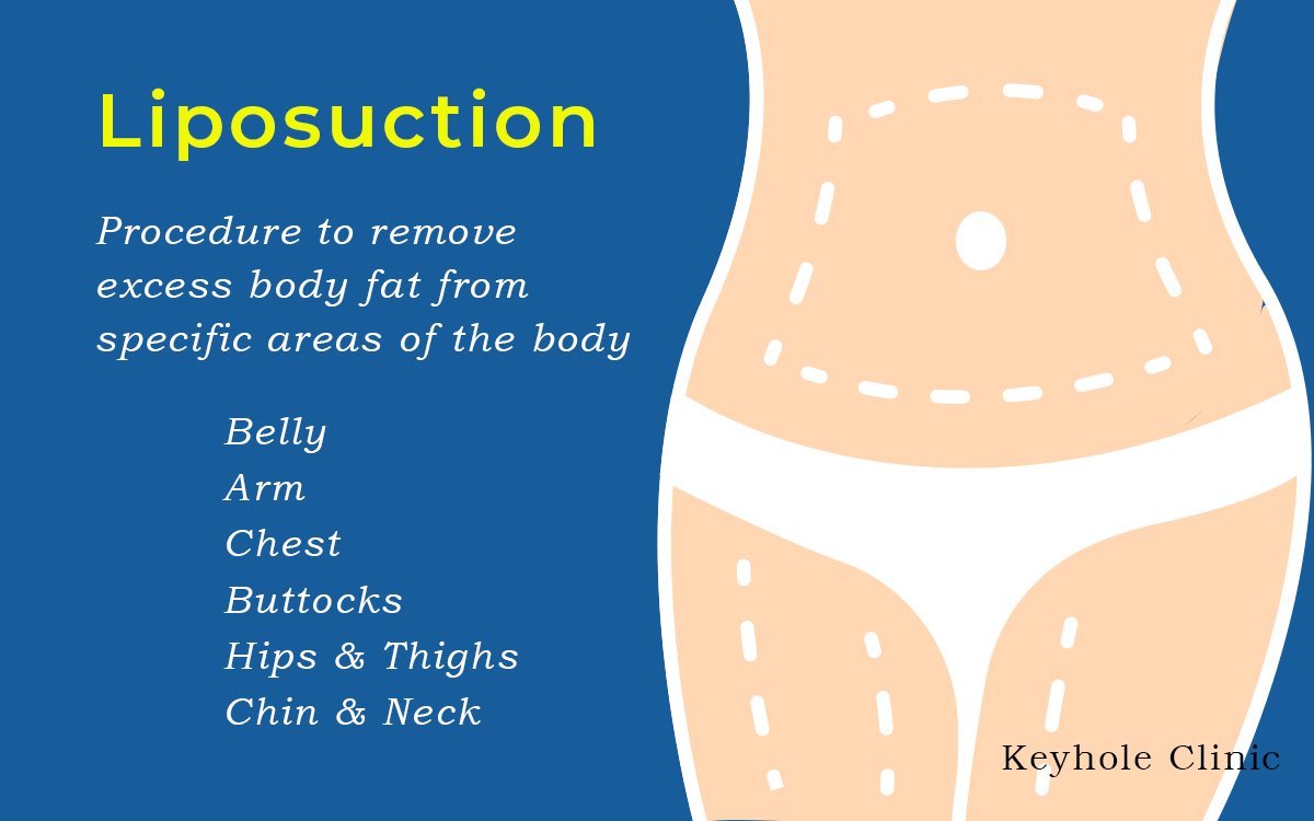 Liposuction in Kerala. Liposuction is a procedure to remove fat from specific parts of the body. Example, Belly fat removal