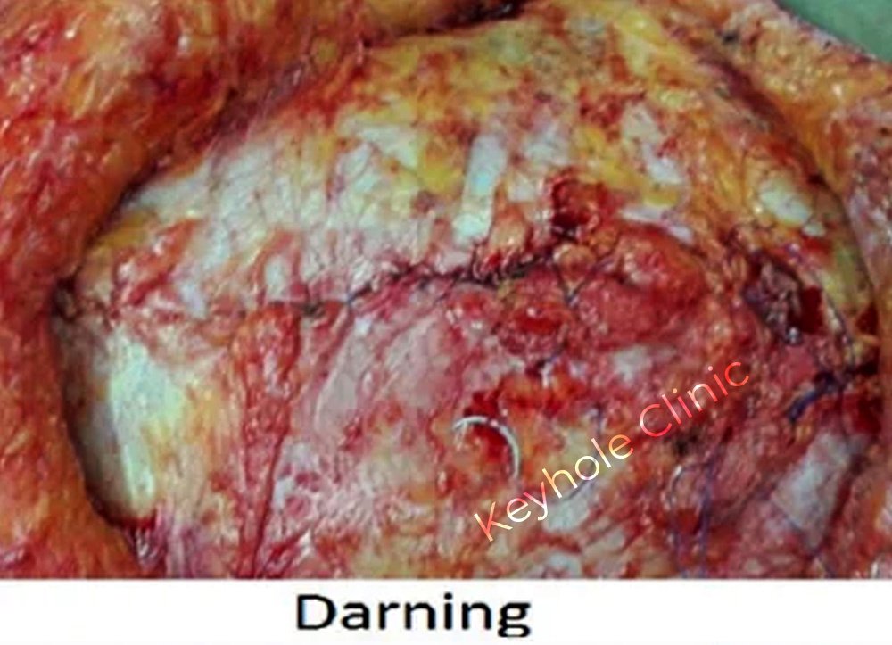 Figure 1: Darning - Presentation of open surgery followed by laparoscopy and open surgery again at last.  