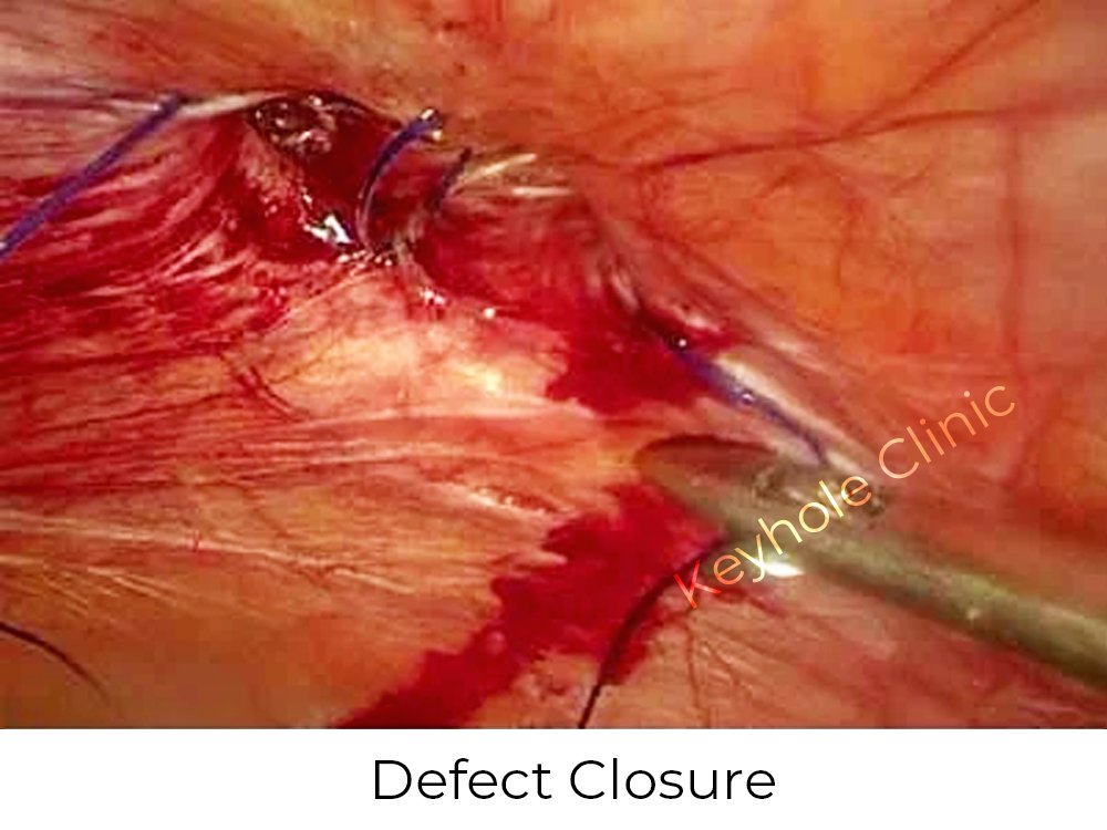 Figure 2: Defect Closure  - hernia repair -  Presentation of laparoscopy followed by open